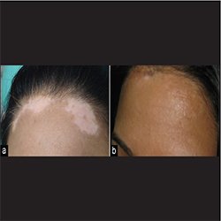 Dermatologists Doctors in Ecil, Moula Ali, kushaiguda, AS Rao Nagar, Neredmet, Malkajgiri, Nagaram, Balaji nagar, Housing Board colony, Hyderabad, Telangana - SkinMax Skin Clinic - Advanced Skin, Hair & Nail Clinic